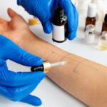 A patients arm being tested for different types of allergy tests