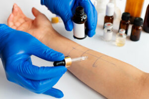 A patients arm being tested for different types of allergy tests